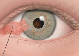 Tratamiento de Pterigium en el ojo